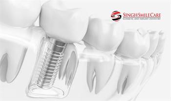 Dental Implants Phoenix | Dentist Near Me | Phoenix Implant Dentist | Dentist 85029